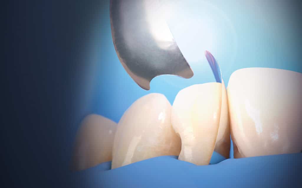 Unica Proximal anterior matrices – Image 2
